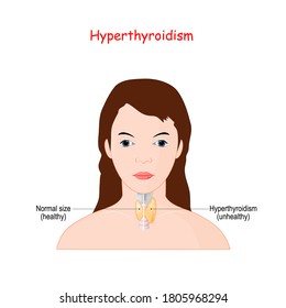 Hyperthyroidism. Woman with thyroid gland. comparison of gland size. Normal (healthy) and enlarged thyroid gland (unhealthy).