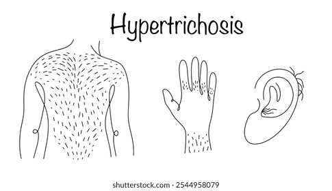 Hipertricose. Uma doença que se manifesta como crescimento excessivo de pelos em várias partes do corpo. Um desenho em linha das costas, dedos e orelhas de um homem com cabelo crescendo sobre eles. Vetor médico.