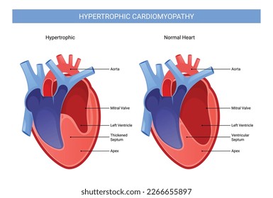 Ilustración infográfica de cardiomiopatía hipertrófica. Eps 10