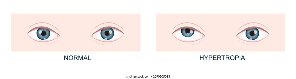 Hypertropia. Vertical strabismus before and after surgery. Human eyes healthy and with upward gaze position. Double vision. Vector cartoon illustration.