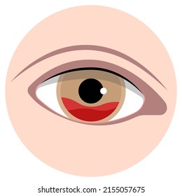 Hyphemas Red Eye Bleeding Injury And Cause Pain Symptoms Sickle Cell Exam