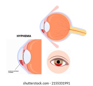 Hyphemas Red Eye Bleeding Injury And Cause Pain Symptoms Sickle Cell Exam