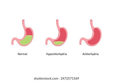 Hypochlorhydria and Achlorhydria Scientific Design. Vector Illustration.