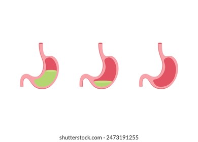 Hypochlorhydria and Achlorhydria Scientific Design. Vector Illustration.