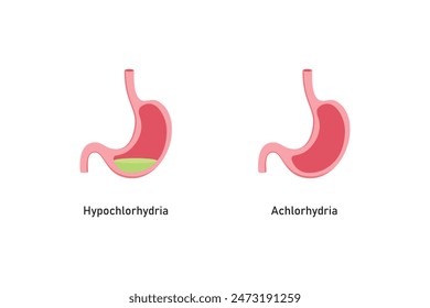 Diseño Científico de Hipoclorhidria y Aclorhidria. Ilustración vectorial.