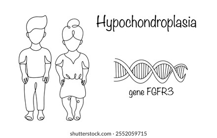 Hipocondroplasia. Doença hereditária caracterizada por formação deficiente de cartilagem e alguns tipos de ossos e levando ao nanismo. Ilustração vetorial.