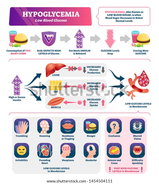 Hypoglycemia vector illustration. Labeled low\
sugar level medical scheme. Chronic diabetes from high carbs\
consumption and obesity. Excess bloodstream insulin educational\
symptoms and causes\
scheme.