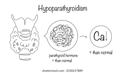 Hipoparatiroidismo. Deficiencia de la hormona paratiroidea, que lleva a una falta de calcio en el cuerpo. Enfermedad tiroidea. Vector aislado sobre fondo blanco.