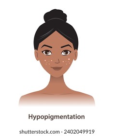 Hypopigmentation and white spots on woman face vector isolated on white background. Skin pigment discoloration, lightened pigment, a low amount of melanin in skin. Skin pigment disorders concept.
