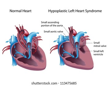 32 Hypoplastic left heart syndrome Images, Stock Photos & Vectors ...