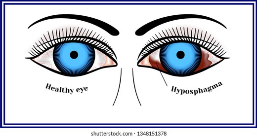 Hypospagma Hemorrhage Sclera Subconjunctival Hemorrhage Stock Vector ...