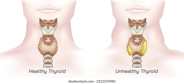 hypothyroidism vs hyperthyroidism. healthy and unhealthy thyroid test. Thyroid tumour and inflammation treatment. Parathyroid glands. neck pain and sore. Throat cancer and esophagus. Goitre problem. 