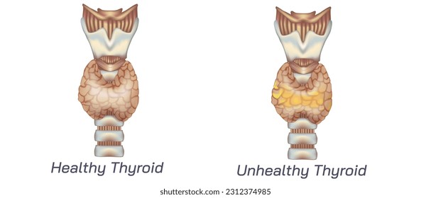 hypothyroidism vs hyperthyroidism. healthy and unhealthy thyroid test. Thyroid tumour and inflammation treatment. Parathyroid glands. neck pain and sore. Throat cancer and esophagus. Goitre problem. 