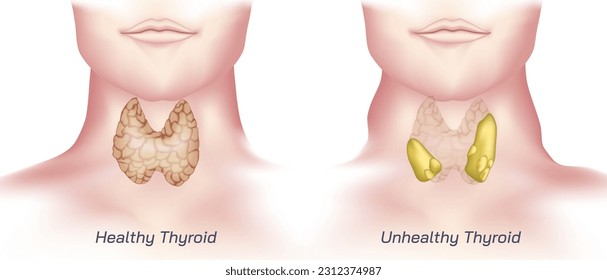 hypothyroidism vs hyperthyroidism. healthy and unhealthy thyroid test. Thyroid tumour and inflammation treatment. Parathyroid glands. neck pain and sore. Throat cancer and esophagus. Goitre problem. 