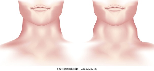 hypothyroidism vs hyperthyroidism. healthy and unhealthy thyroid test. Thyroid tumour and inflammation treatment. Parathyroid glands. neck pain and sore. Throat cancer and esophagus. Goitre problem. 
