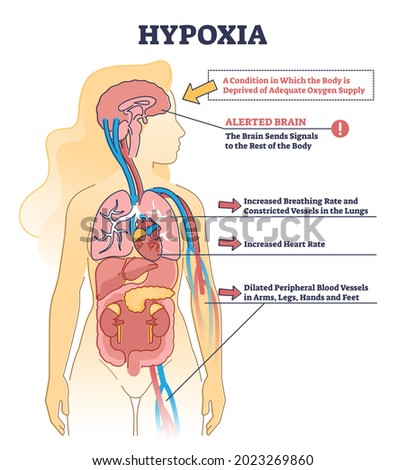 Hypoxia condition as lack of oxygen in brain cells or tissues outline diagram. Labeled medical description with disease symptoms and educational process scheme vector illustration. Hypoxemia disease.