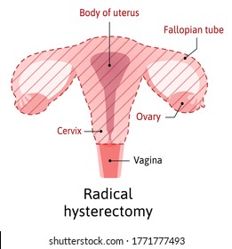 Hysterectomy Surgical Removal Uterus Medical Vector Stock Vector ...