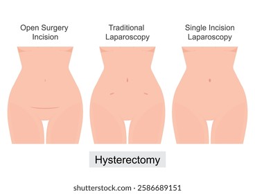 A Hysterectomy is a surgical removal of the uterus. Open Surgery Incision, Traditional Laparoscopy and Single Incision Laparoscopy. Medical health care vector illustration.