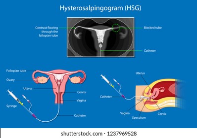 Hysterosalpingogram (HSG) Test Blocked Fallopian Tubes diagnose tubal factor infertility pregnant trouble certain sexually transmitted structural abnormalities uterine exam liquid fluoroscope cancer