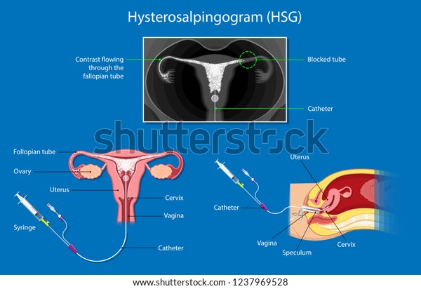 Hysterosalpingogram Hsg Test Blocked Fallopian Tubes Stock Vector Royalty Free 1237969528