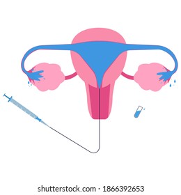 Hysterosalpingogram or HSG, x-ray procedure used to see fallopian tubes and uterus condition. Female reproduction test.