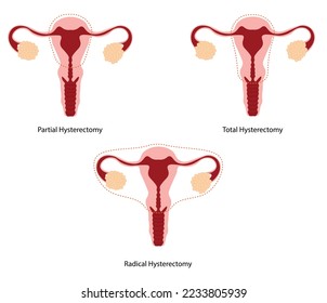 Hysteroscopy surgery type. Diferent types of uterus removal. Gynecology surgeries.
