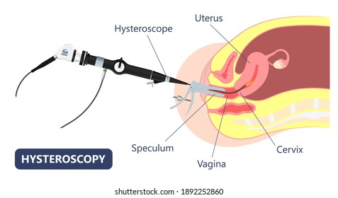 Hysteroscopy uterine treat examine Diagnostic test HSG check tube D and C and womb surgical remove ovary Asherman's menstrual defect pain heavy saline biopsy IVF pelvic cancer cyst In vitro
