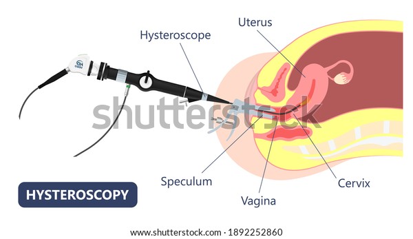 12 Uterine Septum Images, Stock Photos & Vectors | Shutterstock