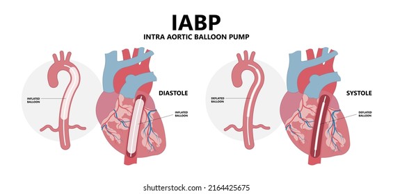 IABP repair lab ICU lung cath left LVAD ECMO care unit artery disease surgeon patient surgery cardiac machine medical heart treat shock attack angina acute defect assist valve stent device bypass