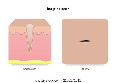 Ice pick scar. Facial skin problems. Vector for advertising about beauty and medical treatment.