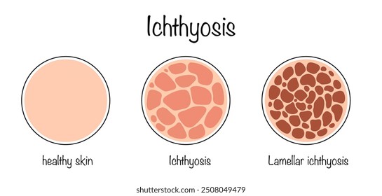 Ichthyosis. A disease characterized by increased keratinization of the skin. The pathology is inherited. Healthy skin and ichthyosis disease. Vector illustration.