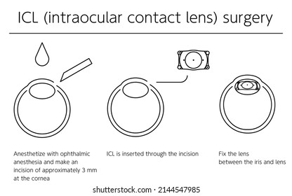 ICL (Intraocular Contact Lens) Surgery, illustrated