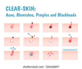 icon acne, schematic view of a derma care, problem skin with pimple in section