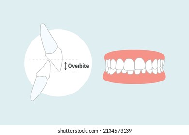 Icon Dental Problem. Vectorial Illustration Overbite 