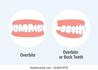 icon dental problem. vectorial illustration  OverBite front and lateral