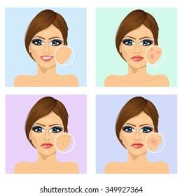 Icon Set For Skincare Infographi. Young Girl With A Problem And Clean Skin Of The Face