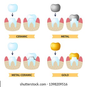 Icons on the dental Theme. Service installation of a ceramic crown. As well as a metal and gold crown on the tooth. Set icons flat style.