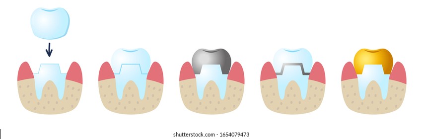 Icons On The Dental Theme. Service Installation Of A Ceramic Crown. As Well As A Metal And Gold Crown On A Tooth. Set Icons Flat Style.