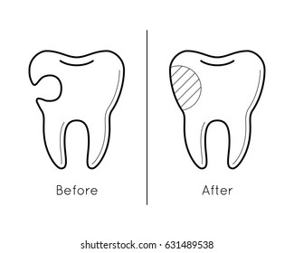Icons of tooth before and after caries treatment in thin line style. Sick and healthy enamel of teeth. Dental problem. Vector outline simple illustrations isolated on white background.