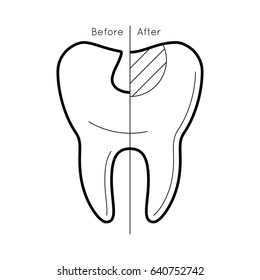 Icons of tooth before and after caries treatment in thin line style. Sick and healthy enamel of teeth. Dental problem. Vector outline simple illustrations isolated on white background.