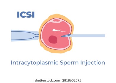 ICSI Intracytoplasmic sperm injection process, concept of assisted reproductive technology and fertility treatment - vector illustration