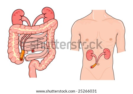 Ileal conduit urostomy