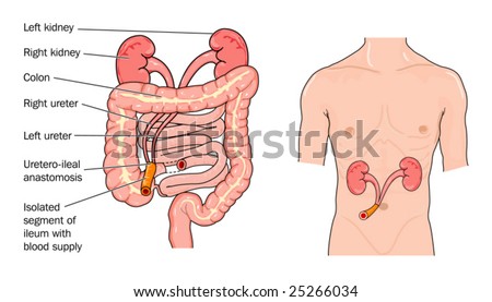 Ileal conduit urostomy - labeled