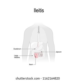 Ileitis is an inflammation of the ileum (part of the small intestine). anatomical locations of jejunum, duodenum, large intestine (colon) and Ileumthe. Human silhouette with internal organs
