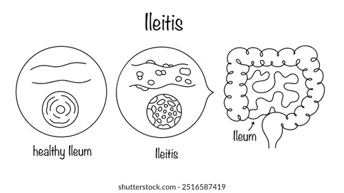 Ileitis. Lesión inflamatoria de la mucosa ileal. Enfermedad intestinal humana dibujada a mano. Ilustración vectorial.