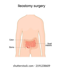 Ileostomy. stoma. surgical opening of small intestine, the ileum out the surface of the skin. surgical procedure. Vector illustration 