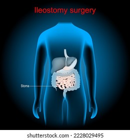 Ileostomy. stoma. surgical opening of small intestine, the ileum out the surface of the skin. surgical procedure. x-ray blue realistic torso with internal organs. Human silhouette on dark background