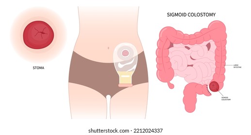 The ileum stoma abdomen Pouch for blocked poo stool system of Small Large Colon with Crohn and Hirschsprung disease inflammation Surgery hernia Cancer tract Rectal Tumor Loop invasive removal