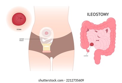 The ileum stoma abdomen Pouch for blocked poo stool system of Small Large Colon with Crohn and Hirschsprung disease inflammation Surgery hernia Cancer tract Rectal Tumor Loop invasive removal