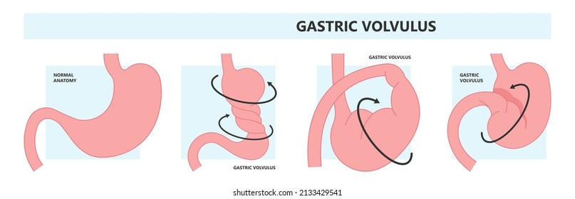 Ileus Bowel Toxic Small Midgut Cecal Colon Tract Hirschsprung's Gastric Ladd Band Large Hiatal Hernia Cancer Tumor Swollen Crohn's X-ray Meckel's Twist Blocked Birth Defect Infant Children Pain Short